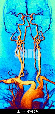 Brust, Hals und Kopf Arterien. Farbige Magnetresonanz-Angiographie (MRA) Scan eines normalen Karotis Systems ein 55 Jahre alter Mann. Unten in der Mitte ist der Aortenbogen, die Kurven über das Herz. Sind die Arterien, die aus diesen Zweigen ab: die Brachiocepha Stockfoto