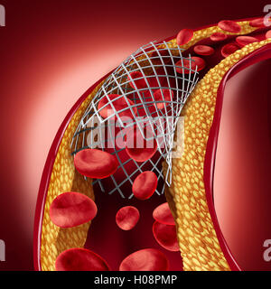 Stent Implantat Konzept als Herz-Kreislauferkrankungen Behandlung Symbol mit einer Angioplastie-Prozedur in einer Arterie, die Cholesterin Plaque Blockade für erhöhte Durchblutung als 3D Darstellung geöffnet hat. Stockfoto