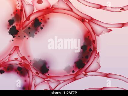 Entzündeten Alveolen in der Lunge Gewebe Slice, Querschnitt, Rauchen Tar Stock Vektor