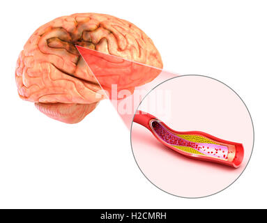 Schlaganfall: 3d Darstellung von Gefäßen des Gehirns und Ursachen eines Schlaganfalls Stockfoto