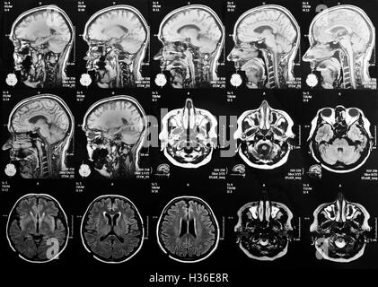 Magnetresonanz-Bildgebung des Gehirns Stockfoto