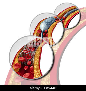 Angioplastie und Stent-Konzept als Herz-Kreislauferkrankungen Behandlung Symbol Diagramm mit den Phasen der eine Implantation in einer Arterie, die Cholesterin Plaque Blockade für erhöhte Durchblutung als 3D Darstellung geöffnet hat. Stockfoto