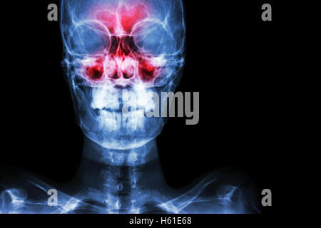 Sinusitis. Film Röntgen Schädel AP (anterior - posterior) zeigen, Infektion und Entzündung an Stirnhöhle, Siebbeinzellen Sinus, Maxil Stockfoto