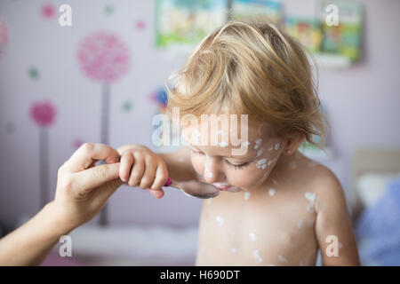 Kleines Mädchen mit Windpocken, Essen Medizin auf Löffel Stockfoto