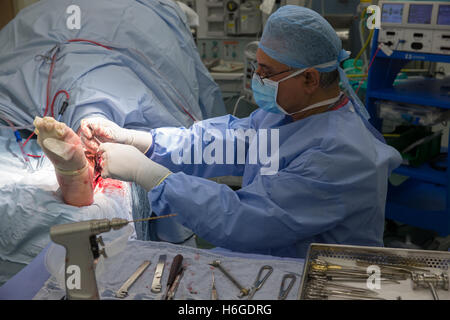 Offenen Reposition und Osteosynthese Knöchel-Sprunggelenk-Operation Stockfoto