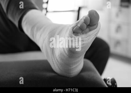 Nahaufnahme eines jungen Mannes Fiberglas / Gips Gipsbein und Zehen nach einer laufenden Verletzung (schwarz & weiß) Stockfoto