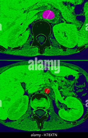 DIE TAKAYASU-ARTERIENENTZÜNDUNG Stockfoto