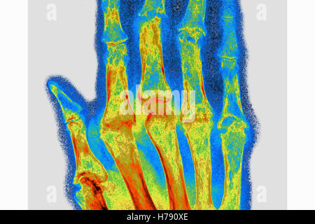 RHEUMATOIDE ARTHRITIS, X-RAY Stockfoto