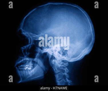 X-ray menschlicher Schädel Stockfoto
