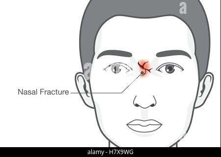 Gebrochene Nase im Gesicht des Mannes. Stock Vektor