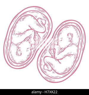 Menschliche Zwillinge Fötus Konzept Hand gezeichnete Vektor Illustration pränatale wachsendes Baby, Umbilicle Kabel isoliert auf einem weißen Hintergrund als Stock Vektor