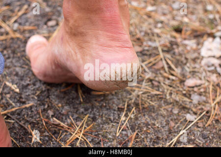 Nahaufnahme Foto paar rissige Fersen. Männliche Rückansicht. Stockfoto