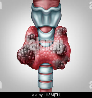 Schilddrüse Krebs Konzept als ein menschliches Organ mit einem bösartigen Tumor-Wachstum als Symbol für Endokrinologie System Krankheit mit 3D Abbildung Elemente. Stockfoto