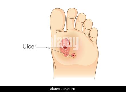 Diabetische Fußschmerzen und Geschwüre. Stock Vektor