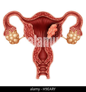Endometriumkarzinom als Gebärmutter oder Gebärmutterkrebs medizinisches Konzept als Krebszellen in einem weiblichen Körper Angriff auf das reproduktive System als Symbol der Stockfoto