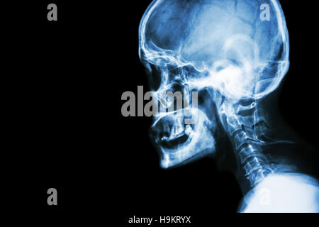 X-ray Film Skull Seitenansicht zeigen normale menschliche Schädel und Halswirbelsäule und leeren Bereich auf der linken Seite Stockfoto