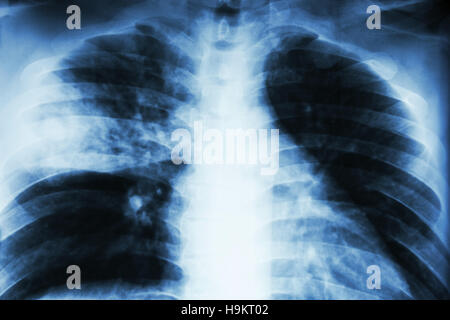 Lobäre Pneumonie. Röntgen der Film zeigen alveoläre Infiltration am rechten mittleren Lappen wegen Tuberkulose-Infektion. Stockfoto