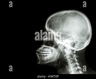 Film Röntgen Schädel und Halswirbelsäule Seitenansicht. leeren Bereich auf der linken Seite Stockfoto