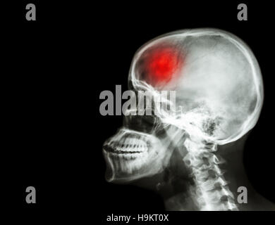 Schlaganfall. Film Röntgen Schädel und Halswirbelsäule Seitenansicht und Schlaganfall. Apoplexie. leeren Bereich auf der linken Seite. Stockfoto