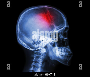 Schlaganfall. Film Röntgen Schädel Seitenansicht zeigen menschliche Schädel und Schlaganfall. Apoplexie. isolierte Hintergrund Stockfoto