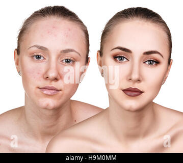 Frau mit problematischer Haut im Gesicht Stockfoto