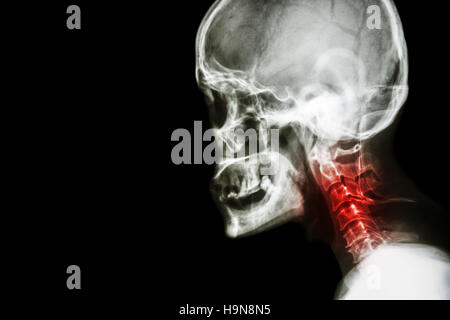 Zervikale Spondylose. Film Röntgen Schädel seitliche Ansicht und Nacken Schmerzen. Stockfoto