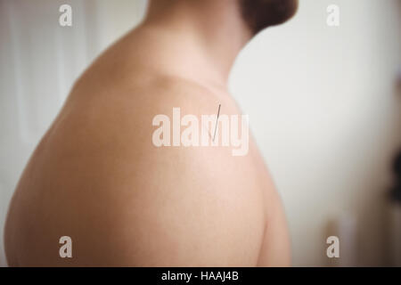 Nahaufnahme eines Patienten immer trockene Vernadelung Stockfoto