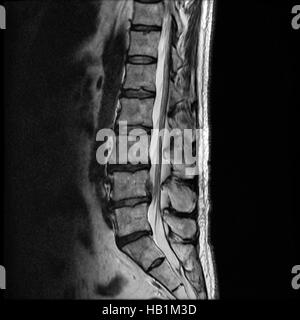 MRT von einer lumbalen Scheibe Herniation Stockfoto