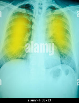 Röntgenuntersuchung der Brust für die Diagnose mit gelben Punkt entzündliche Stockfoto
