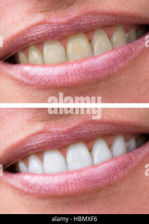 Zähne der Frau vor und nach der Aufhellung Stockfoto