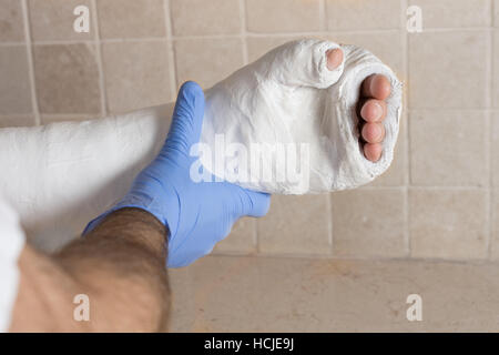 Orthopädie-Techniker setzen auf eine Glasfaser / Gips auf einen jungen Mann gebrochen und gebrochenen Arm nach einer Verletzung.  Nahaufnahme Bild zeigt die Besetzung Stockfoto