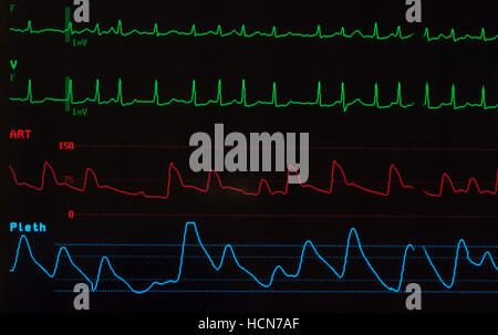 Nahaufnahme von medizinischer Monitor mit EKG bei Vorhofflimmern, arterieller Blutdruck Welle und Sauerstoff Sättigungsniveau. Stockfoto