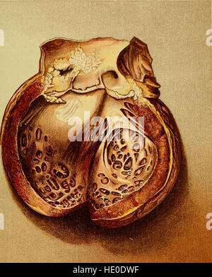 Krankheiten des Herzens und der arteriellen System - entwickelt, um eine praktische Präsentation des Themas für den Einsatz von Studenten und Praktiker der Medizin (1907) Stockfoto