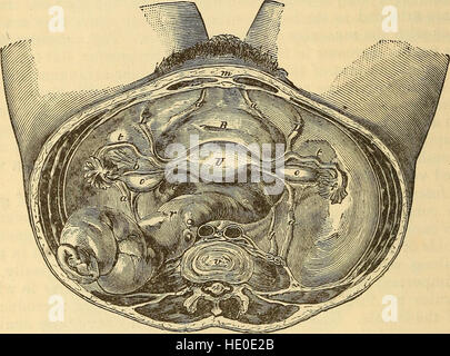 Eine Abhandlung über die Wissenschaft und Praxis der Geburtshilfe (1880) Stockfoto