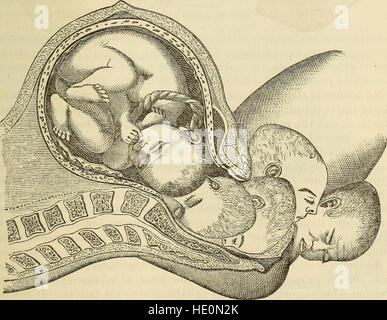 Ein System der Geburtshilfe, einschließlich der Krankheiten der Schwangerschaft und der Brustwand Staat (1875) Stockfoto