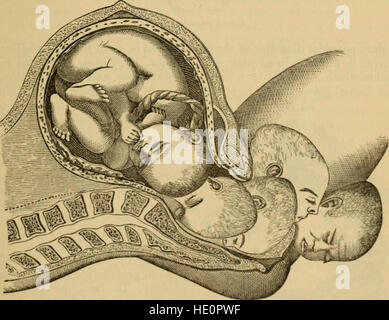 Ein System der Geburtshilfe - einschließlich der Erkrankungen der Schwangerschaft und der Brustwand Staat (1875) Stockfoto