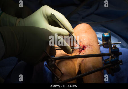 Ein Arzt näht sich eine offene Wunde an einem Patienten während einer Operation bei Craig-Joint Theater Hospital, 10. Juni 2016, Bagram Airfield, Afghanistan. In dem Bemühen, die Patienten retten Bein, leiden an einer Schusswunde haben Chirurgen platziert eine Klappe der Haut von der Rückseite ihrer Beine über die Wunde, um Infektionen zu verhindern und die Heilung fördern beschafft.  Techn. Sgt Tyrona Lawson) Stockfoto