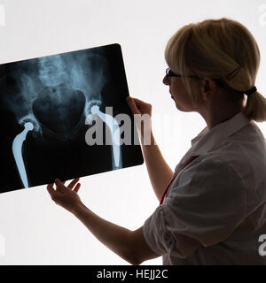 UK Health Care Professionals: A National Health Service (NHS) weibliche Ärztin Blick auf eine Reihe von Röntgenbildern einer doppelten Hüftgelenkersatz-Operation Stockfoto