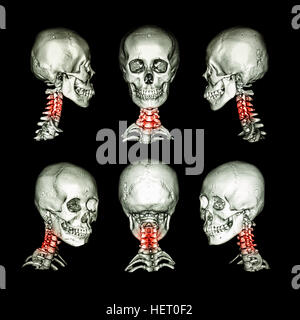 CT-Scan und 3D Bild des Schädels und des Halses. Verwenden Sie dieses Bild für zervikale Spondylose, Spondylolisthesis, Bechterew Wirbelsäule Trauma Zustand. Stockfoto