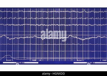 SCHLAF-APNOE-SYNDROM Stockfoto