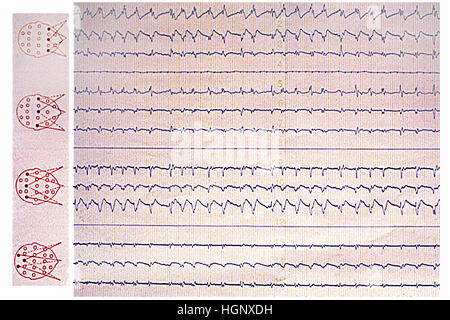 SCHLAF-APNOE-SYNDROM Stockfoto
