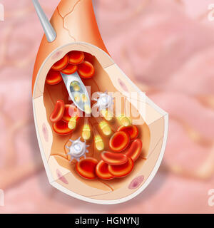 STRAHLENTHERAPIE, ILLUSTRATION Stockfoto