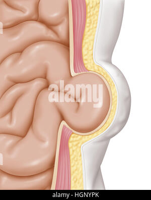 ABDOMINAL-HERNIE Stockfoto