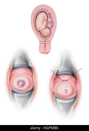 Zervikalen Cerclage, eine Operation verwendet, um einen inkompetenten Hals während der Schwangerschaft geschlossen zu halten. Bereich der Behandlung (oben), werden vor Behandlung Ansicht gezeigt Stockfoto