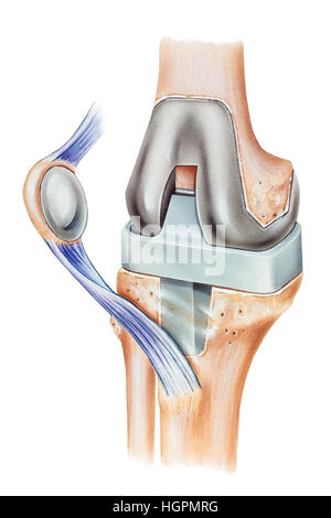 Abbildung von einer Knie-Totalprothese, zeigt eine Patella Prothese, einen Querschnitt der Patella mit der Patella Ersatz in Plac zementiert Stockfoto