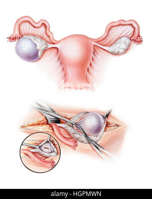 Eierstöcke - ovarielle Zystektomie chirurgische Entfernung eine Ovarialzyste. Gezeigt werden eine Ovarialzyste im linken Eierstock (oben), Dissektion der Zyste aus der ova Stockfoto