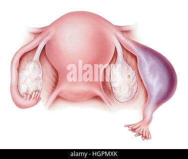 Eine Eileiterschwangerschaft. Gezeigt werden eine normale Eileiter (links) und eine Eileiterschwangerschaft in einem Eileiter (rechts). Eine ektopische Schwangerschaft auftritt, wenn Stockfoto