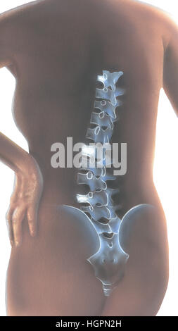 Wirbelsäule - Schmerzen im Rücken. Hintere Ansicht einer Frau zurück, die Schmerzen in der Lenden- und Brustwirbel Wirbel. Stockfoto