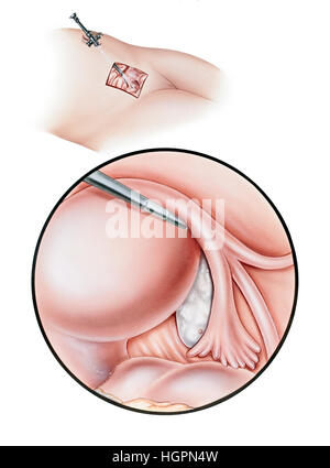 Chirurgie - Diagnostische Laparoskopie. Gezeigt werden breite Cutaway (oben) und (unten) Ansichten, die darstellen Laparoskop, Eierstöcke, Eileiter, Fibria hautnah Stockfoto