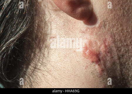 Hautkrebs auf Mann Wange hautnah Stockfoto